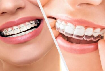 BRACES TREATMENT