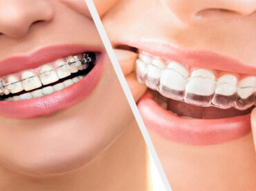 BRACES TREATMENT