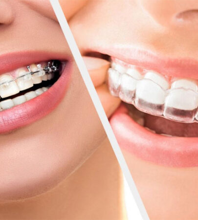 BRACES TREATMENT