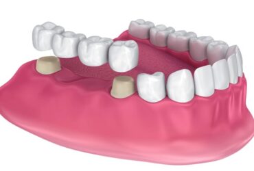 DENTAL BRIDGES