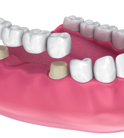 DENTAL BRIDGES