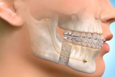 MAXILLOFACIAL