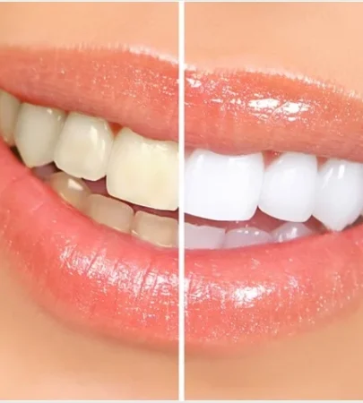 TEETH WHITENING