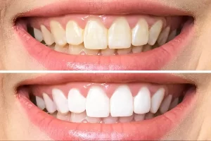 The Ultimate Guide to Teeth Whitening in Kadavanthra