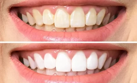 The Ultimate Guide to Teeth Whitening in Kadavanthra