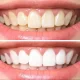 The Ultimate Guide to Teeth Whitening in Kadavanthra